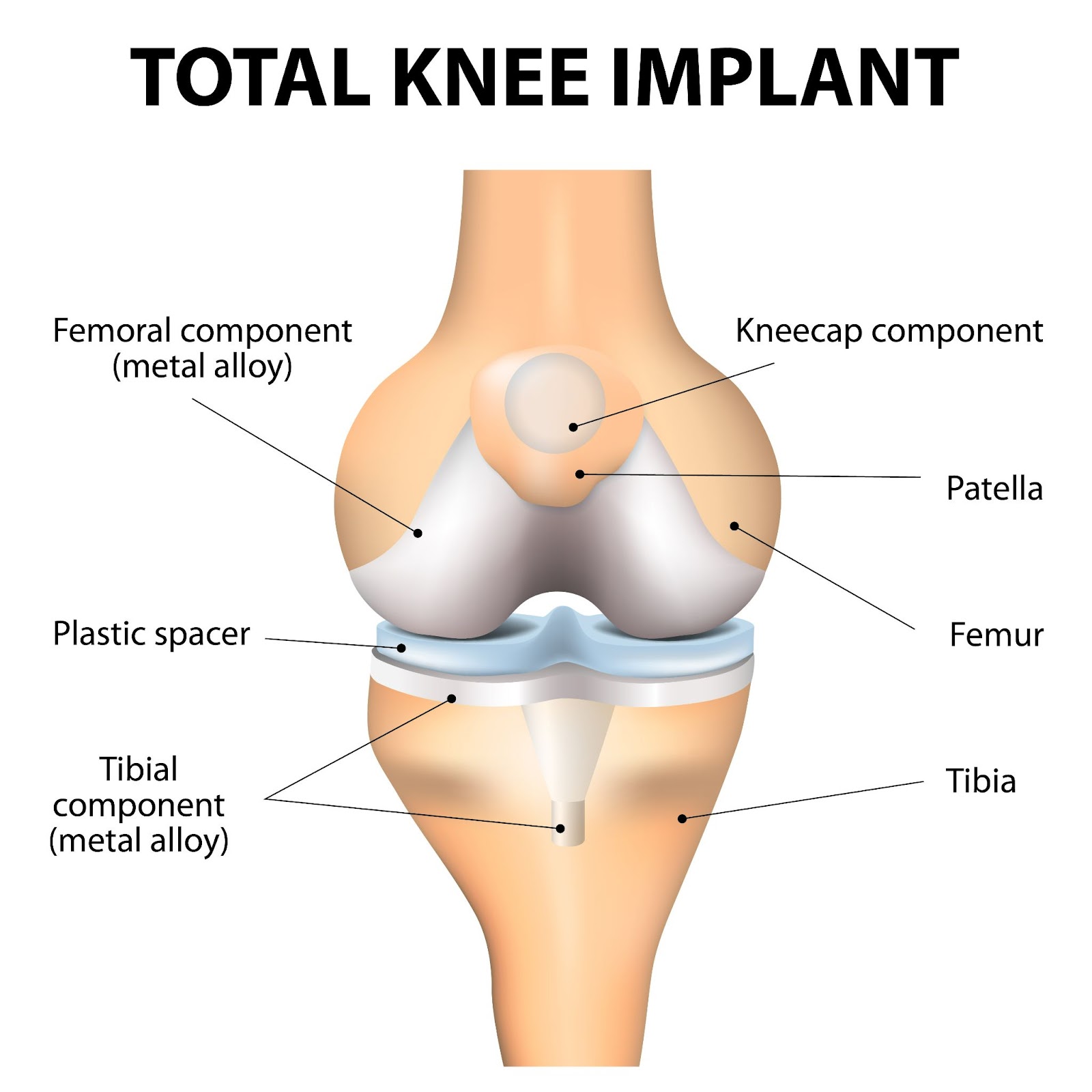 robotic_bilateral_knee_replacement Best robotic bilateral knee replacement doctor in Jaipur
